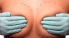 Cirujano plástico explicó las instancias en las que se puede aplicar una reducción mamaria
