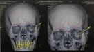 Médicos extrajeron cuchillo alojado en cráneo de un zapatero desde 1995
