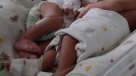 Siamesas nacieron unidas por el abdomen en Bolivia