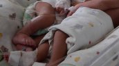 Siamesas nacieron unidas por el abdomen en Bolivia
