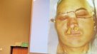 Primer trasplante de rostro en Polonia concluyó positivamente