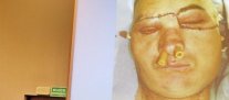 Primer trasplante de rostro en Polonia concluyó positivamente