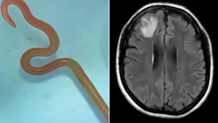   Médicos descubrieron gusano vivo dentro de un cerebro humano 