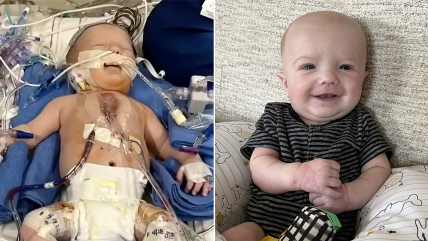   Bebé de 18 días recibió inédito trasplante parcial de corazón 
