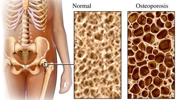 Llegó a Chile fármaco contra osteoporosis que se aplica sólo una vez al año