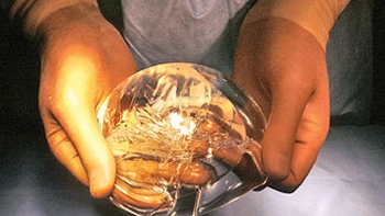   Cirujano plástico pidió que implantes mamarios mal fabricados sean retirados de pacientes 