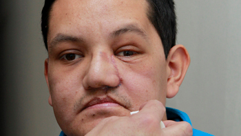   Rostro de hombre ecuatoriano fue reconstruido con cerámica 