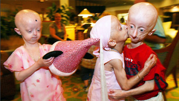   Científicos identificaron gen que causa el envejecimiento prematuro 