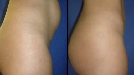 Especialista advirtió sobre los riesgos de la abdominoplastía tras una cesárea