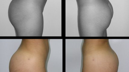 Especialista expuso los beneficios y procedimientos de una gluteoplastía