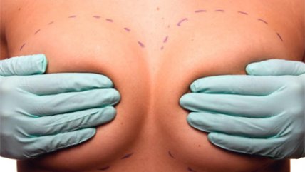 Cirujano plástico explicó las instancias en las que se puede aplicar una reducción mamaria