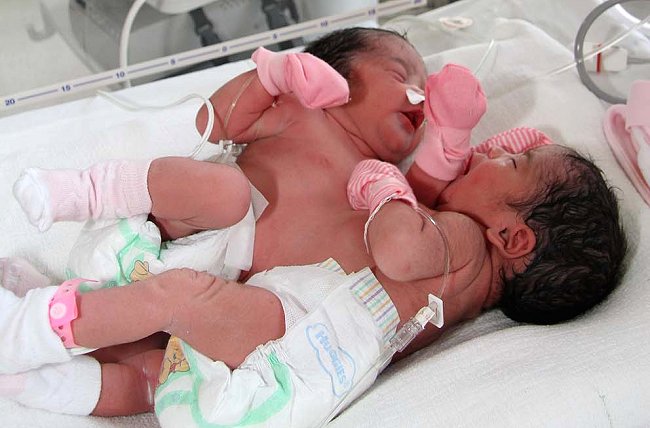 Siamesas separadas duermen con muñecas para no echarse de menos