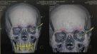 Le extrajeron cuchillo alojado en el cráneo desde 1995