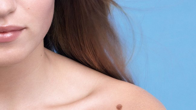 Promueven jornadas gratuitas de detección y prevención del cáncer a la piel