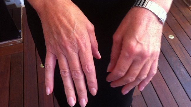 Mujer padece enfermedad que la hace oler a pescado podrido