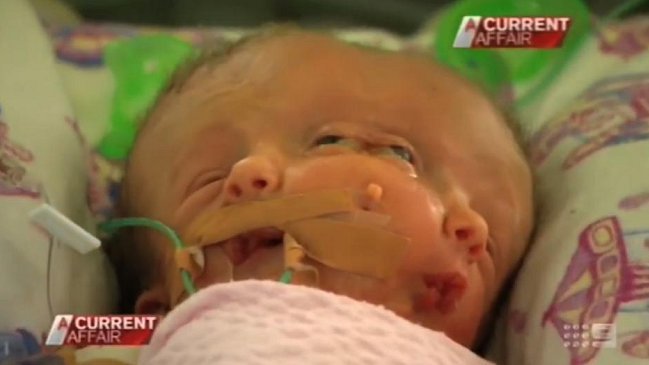 Mellizas con dos caras en un solo cráneo nacieron en Australia