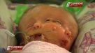 Mellizas con dos caras en un solo cráneo nacieron en Australia