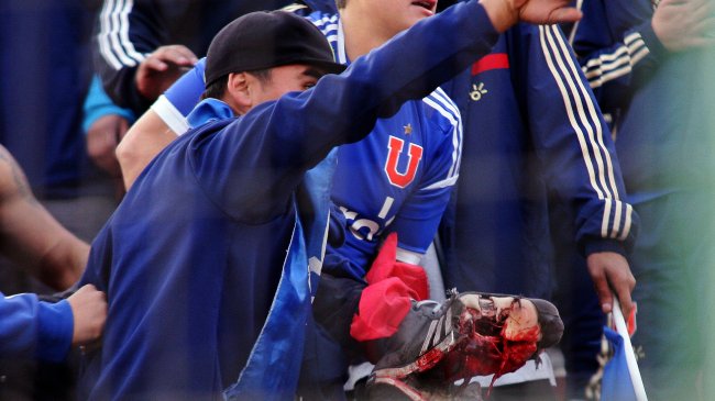 Hincha de Universidad de Chile sufrió amputación tras estallido de bomba de ruido
