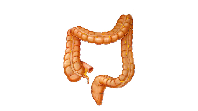 Cerca de 15 mil chilenos sufren de Colitis Ulcerosa