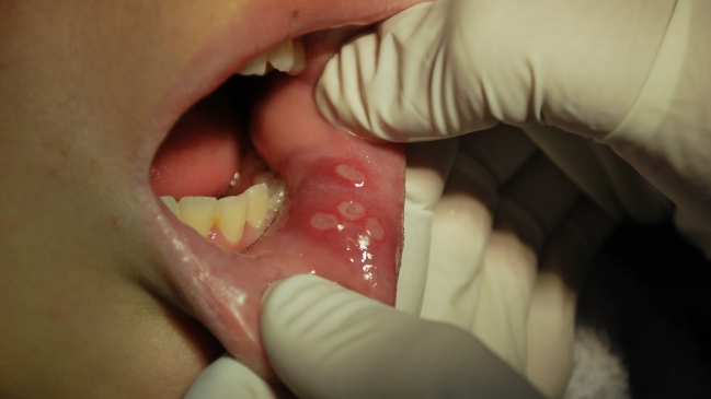 ISP pidió limitar uso de lidocaína y benzocaína en niños