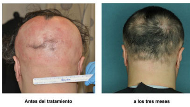 Descubren medicamento que revierte pérdida de cabello