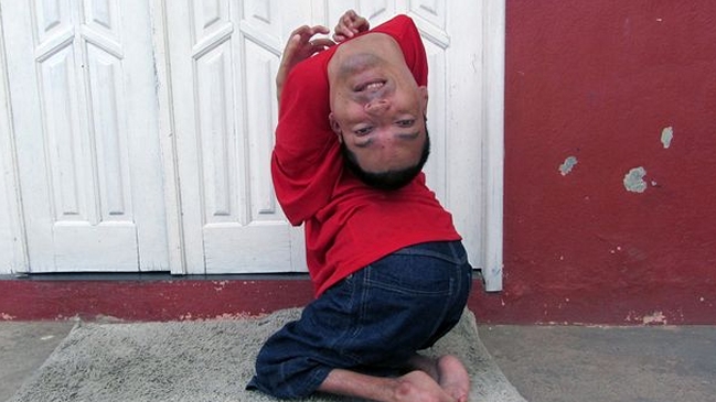 La inspiradora historia del brasileño que nació con la cabeza al revés