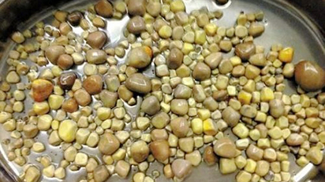 Médicos extrajeron 420 cálculos renales a paciente causados por 