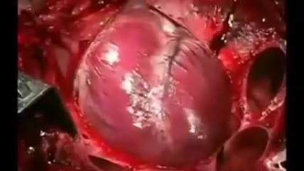   Cómo se ve el corazón de una persona durante un infarto 