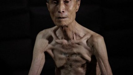 Las secuelas de la bomba atómica en el cuerpo de un sobreviviente