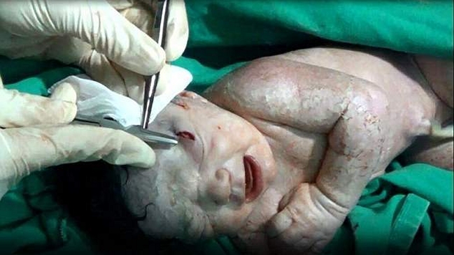 Bebé nació con una herida de la esquirla que hirió a su madre en Siria
