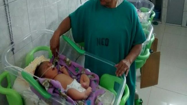 Niño nació con dos narices en Perú