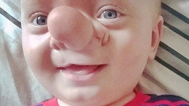 El bebé de 21 meses cuyo cerebro crecía en su nariz