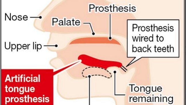 Desarrollaron en Japón la primera prótesis de lengua capaz de moverse