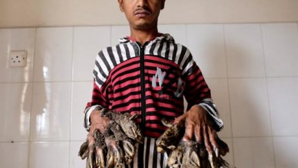   La extraña enfermedad que convierte a un hombre en 