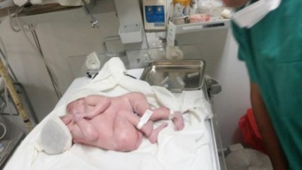 La Historia es Nuestra: Casos de siameses se originan solo en el azar, dice doctor Osvaldo Artaza