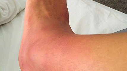 Alexis Sánchez mostró como quedó su tobillo tras la final con Argentina