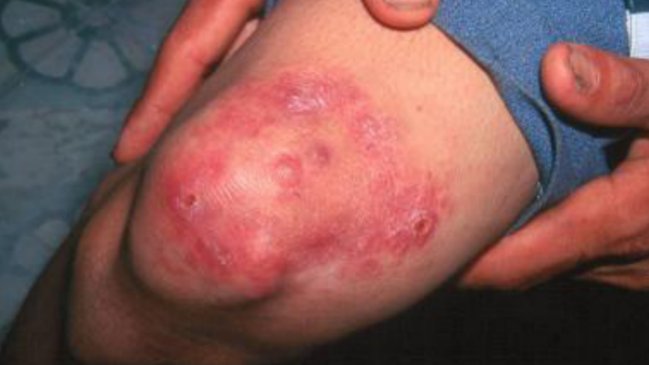 Región de Los Ríos: Caso sospechoso sí corresponde a lepra