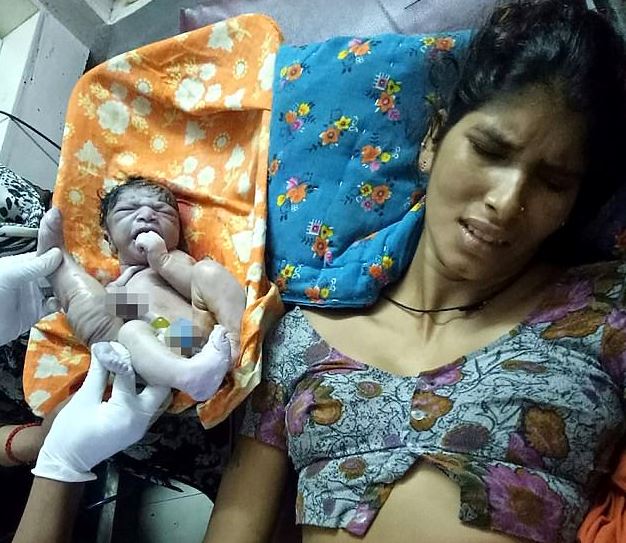 Niño nació con cuatro piernas y tres manos en India