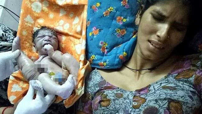 Niño nació con cuatro piernas y tres manos en India
