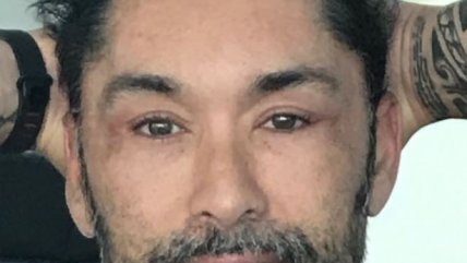  Cirujano plástico explicó las operaciones que se realizó Marcelo Ríos  