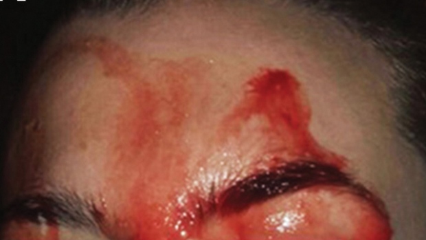 Mujer que transpira sangre desconcierta al mundo médico