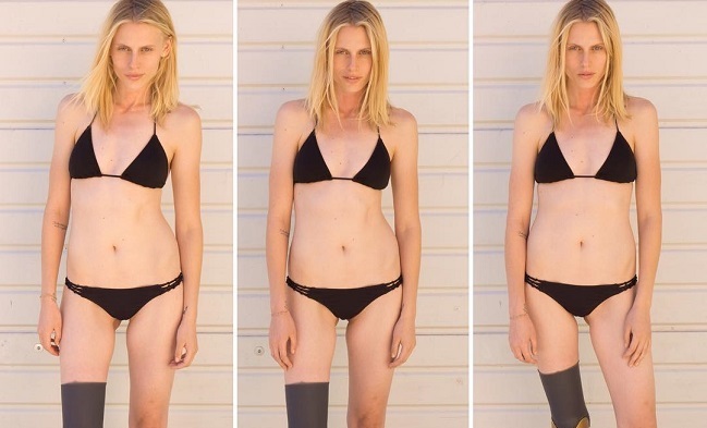 Supermodelo que perdió la pierna infectada por un tampón sufrirá nueva amputación