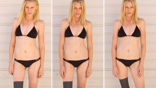 Supermodelo que perdió la pierna infectada por un tampón sufrirá nueva amputación