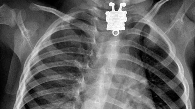 Los objetos que los estadounidenses metieron en sus orificios durante 2017