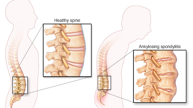 Reumatólogos piden que se incluya espondilitis anquilosante en la Ley Ricarte Soto