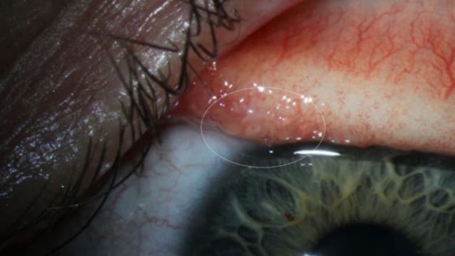 Inédita infección: Encuentran 14 gusanos en el ojo de una mujer
