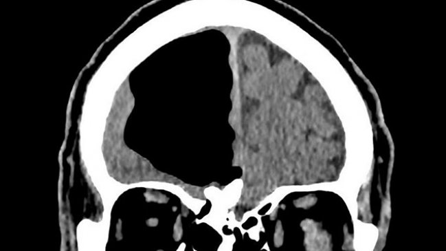Médicos hallaron un hueco de aire en el cerebro de un hombre