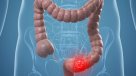 Mes de Concientización del Cáncer de Colon: Consejos para detectar y evitar la enfermedad
