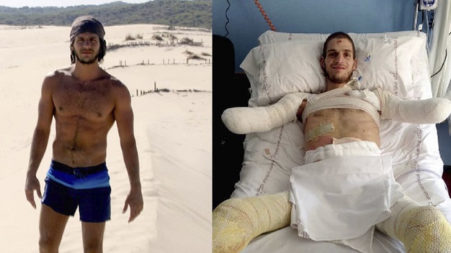 La historia del italiano al que amputaron los brazos y piernas tras diagnóstico erróneo