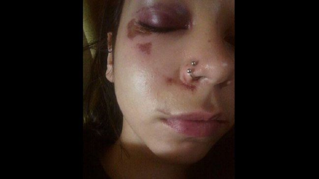 Joven denunció brutal golpiza de un hombre que la acosó en calles de Valparaíso